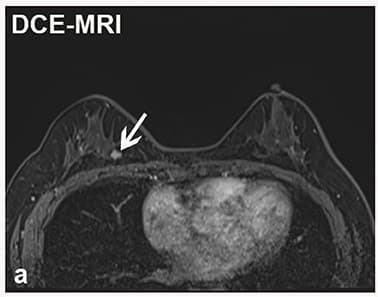 유방 MRI 참고 영상
